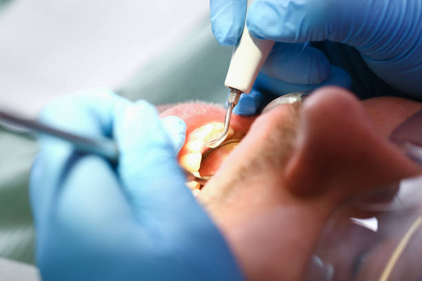 Best Emergency Tooth Extraction in Bend, OR