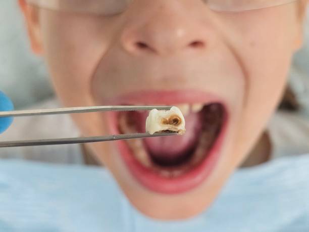 Best Emergency Dental Care for Broken or Chipped Teeth in Bend, OR